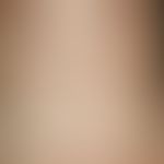 Anetodermia. inflammatory anetodermia (type Jadassohn). 0.5 cm to 1.5 cm large, reddish-brownish,...