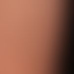 Anetodermia : Slightly conspicuous, slightly reddened, symptomless, flat skin depressions with at...