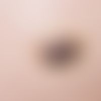 Angiokeratom. Zum Teil thrombosierter (schwarze Anteile), der Hautoberfläche "aufsitzender" Knote...