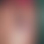 angiokeratoma, solitary. for more than 10 years existing, initially flat, in the last months clea...