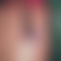 angiokeratoma, solitary. for more than 10 years existing, initially flat, in the last months clea...