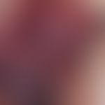 Angiokeratoma, solitary. reflected light microscopy: Round, oval or polygonal, partly confluent, ...