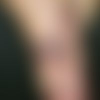 Angiokeratoma circumscriptum. Großflächig konfluierende Angiokeratome im Bereich des Fußes mit ka...