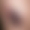 Angiokeratoma circumscriptum. 20 Jahre alte Patientin mit einer aus mehreren Effloreszenzentypen ...