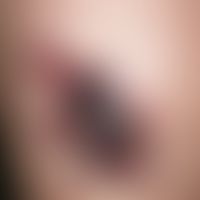 Angiokeratoma circumscriptum. 20 Jahre alte Patientin mit einer aus mehreren Effloreszenzentypen ...