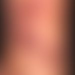 Angiokeratoma circumscriptum:&nbsp;seit Geburt bestehende vaskuläre Malformation, die in den letz...
