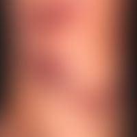 Angiokeratoma circumscriptum:&nbsp;seit Geburt bestehende vaskuläre Malformation, die in den letz...