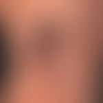 Angiokeratoma circumscriptum. Lokalisierte vaskuläre Malformation mit bizarren, blau-schwarzen&nb...