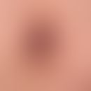 Angiokeratoma corporis diffusum: Periumbilical localized, disseminated, partly spatter-like, part...