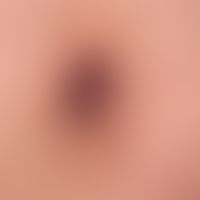 Angiokeratoma corporis diffusum: Periumbilical localized, disseminated, partly spatter-like, part...
