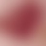 Angiokeratoma corporis diffusum. Auflichtmikroskopie (Herd in der Nabelregion einer 41-jährigen F...