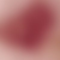 Angiokeratoma corporis diffusum, reflected light microscopy (focus in the navel region of a 41-ye...