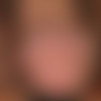 Angiokeratoma der Glans penis. Übersichtsaufnahme: Bläulich-livide, hyperkeratotische Papeln in l...
