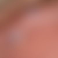 Angiokeratoma der Glans penis. Detailvergrößerung: Bläulich-livide, hyperkeratotische, weiche&nbs...
