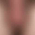Angiokeratoma scroti et vulvae. 39-year-old man has chronic inpatient multiple, isolated standing...