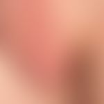 scrotal and vulval angiosclerosis
