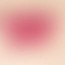 Angioleiomyom. Scharf zur Umgebung abgesetzter Tumor im mittleren und tiefen Korium; deutliche Eo...