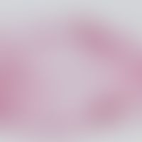 Angiolipom. Umschriebener, mit einer zarten Bidegewebskapsel versehener Tumor aus reifen Adipozyt...