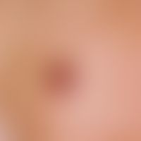 Angiom, seniles:&nbsp;seit Jahren bestehender, rot brauner, sehr weicher, durch Fingerdruck nahez...