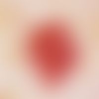 Angiom, seniles (Auflichtmikroskopie): scharf begrenzter, teils aus isolierten (Randbereich), tei...