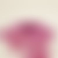 Angiom, seniles. Konvolute kapillärer Gefäßknäuel im oberen Korium. Epidermis über der Gefäßneubi...
