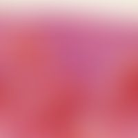 Angiom, seniles (Detailvergrößerung):&nbsp;geringe unregelmäßige Akanthose des Epithels; Orthoker...