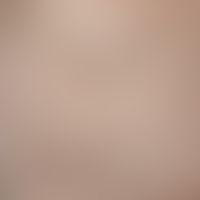 Angioma, senile. multipe, chronically stationary,1-4 mm large, sharply defined, initially light r...