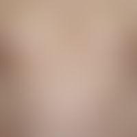 Angioma, senile, multiple, bright red, persistent, hardly increasing in size, disseminated standi...