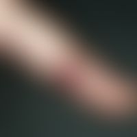 Angioma, senile. 55 years old female patient, in whom this finding has existed for two years. Siz...