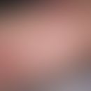Angioma serpiginosum:&nbsp;Seit mehreren Jahren bestehende, völlig symptomlose, girlandenförmige ...