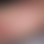 Angioma serpiginosum:&nbsp;Seit mehreren Jahren bestehende, völlig symptomlose, girlandenförmige ...