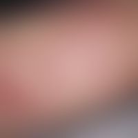 Angioma serpiginosum:&nbsp;Seit mehreren Jahren bestehende, völlig symptomlose, girlandenförmige ...