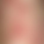 Angiomatosis, bacillary enlargement, partly isolated, partly grouped hemorrhagic papules up to ap...