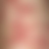 Angiomatosis, bacillary enlargement, partly isolated, partly grouped hemorrhagic papules up to ap...