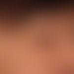 Angioedema.
