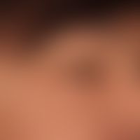 Angioedema.

