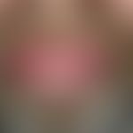 Angioödem, erworbenes, Renin-Angiotensin-Aldosteronsystemblocker-induziertes. Akute, prall-elasti...