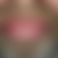 Angioödem, erworbenes, Renin-Angiotensin-Aldosteronsystemblocker-induziertes. Akute, prall-elasti...