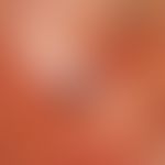angiosarcoma of the head and facial skin. for several years (!) increasing, so far completely asy...