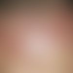 Angiosarcoma of the skin of the head and face. flat, smooth, asymptomatic, chronically dynamic, s...