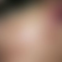 Angiosarkom der Kopf- und Gesichtshaut. Langsamer, chronischer Verlauf ohne subjektive Beschwerde...