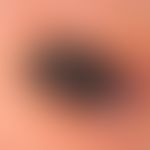 Angiosarcoma of the head and facial skin: the 69-year-old patient noticed this rapidly growing an...