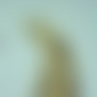 Ankylostomiasis. head of the adult hookworm Necator americanus. there are two crescent-shaped cut...