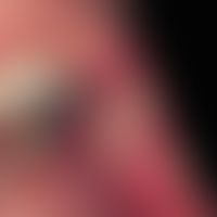 Aphthae: Approx. 3 cm large, bizarrely limited, painful, solitary aphthae in a 42-year-old man, p...