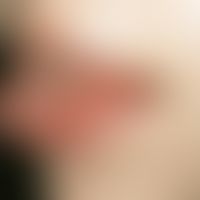 aphthae, habitual: sharply defined, greasy coated, very painful ulcers at the edge of the tongue....