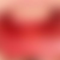 Aphthae, habitual: smeary-coated, very painful ulcers on the lower lip in a 20-year-old female pa...