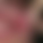 Aphthen, habituelle: schmerzhafte, weißlich belegte, scharf begrenzte Ulzerationen mit gerötetem ...