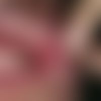 Aphthae, habitual: painful, whitish, sharply defined ulcerations with reddened margins in the lip...