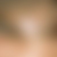 Aplasia cutis congenita. Seit Geburt bestehendes, scharf begrenztes, weiß-gelbliches, flach einge...