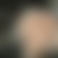 Aplasia cutis congenita. Detailvergrößerung: Klassisch spiegelnde, leicht eingesunkene, hellgelbe...